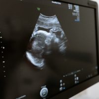 Il divieto di aborto? Non mina la salute delle donne. Guardare la Polonia